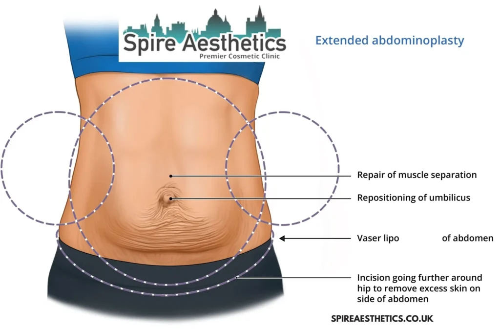 Understanding Loose Skin After Gastric Band Lewes Surgery and HIFU Treatment