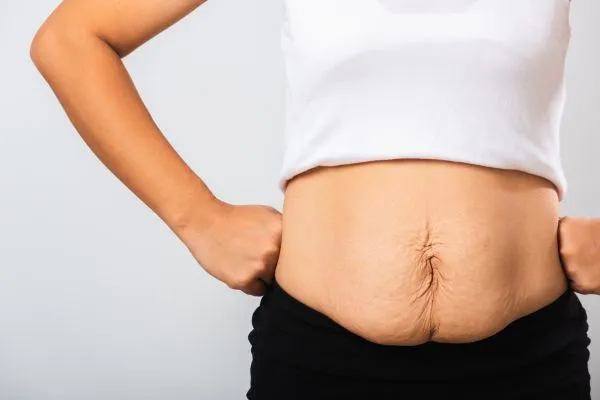 Image of a woman's stomach after weight loss with sagging skin following a gastric band Lewes