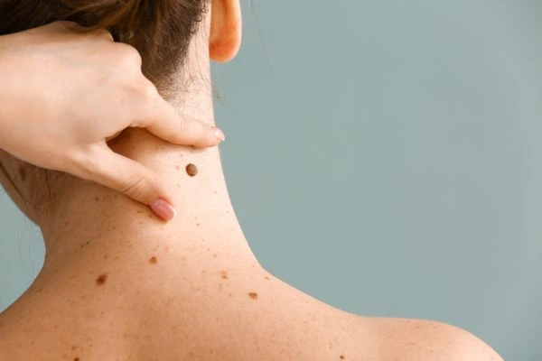 skin blemish removal Lewes treatment