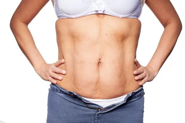 sagging skin on woman's stomach after weight loss injections Lewes