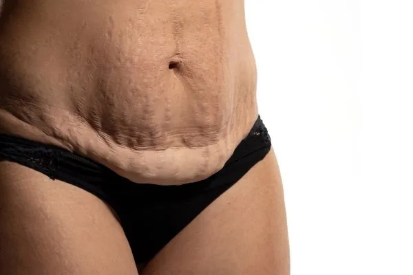 Image of womans stomach after weight loss injections Lewes showing saggy skin